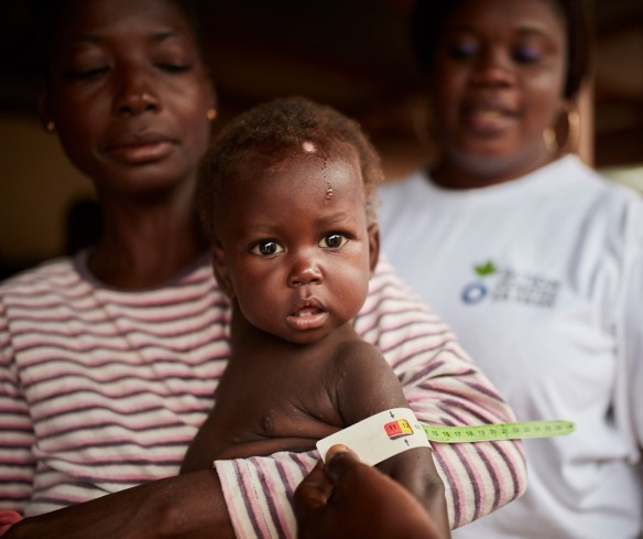 A boy's upper arm is measured with a color-coded band to determine his malnutrition status. His arm is very thin and found in the "red" category, an indication of severe acute malnutrition.