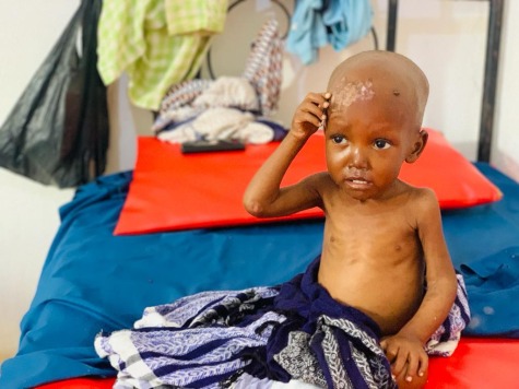 Two-year-old Adan suffers from severe malnutrition.